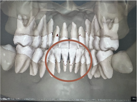 CT画像で歯根露出のリスクを確認