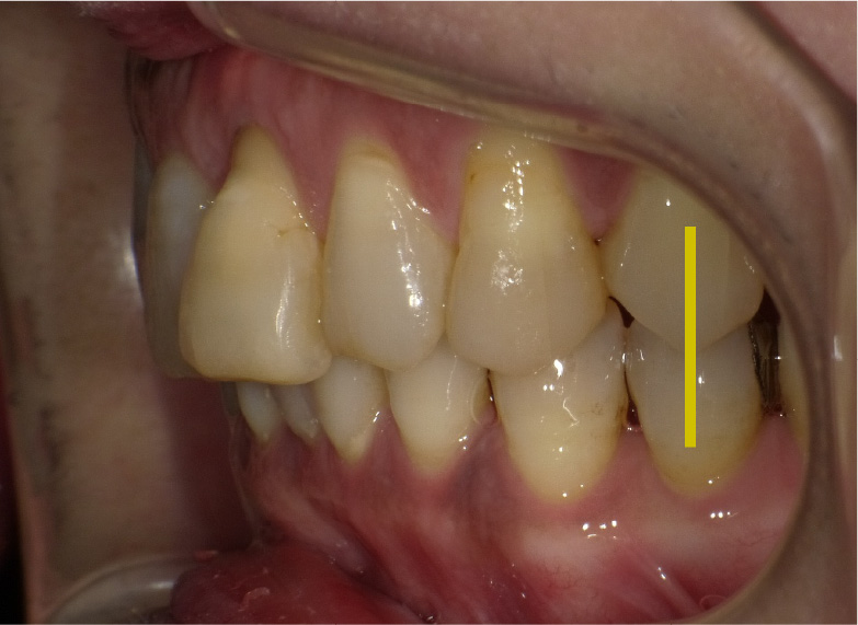 4番目の歯が垂直に噛み合い当たっている状態